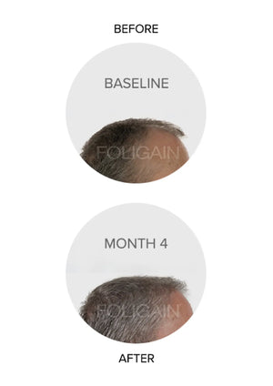 FOLIGAIN BEFORE AFTER