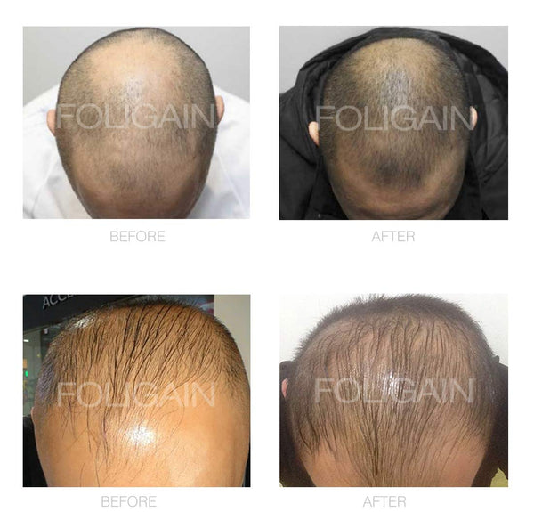 FOLIGAIN Minoxidil 5% Hair Regrowth Foam For Men 3 Month Supply - FOLIGAIN EU